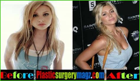 Aly Michalka Plastic Surgery Before and After